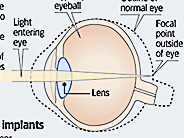 lens graphic