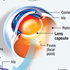 Lens replacement